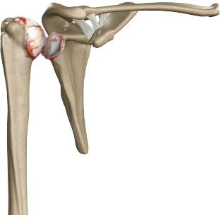 Osteoarthritis of the Hip
