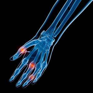 Surgery for Thumb and Digit Arthritis