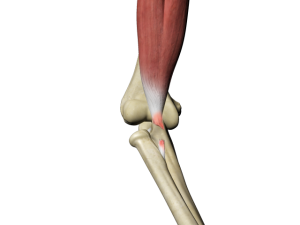 Distal Biceps Tendon Tear