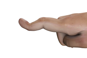 Boutonnière Deformity