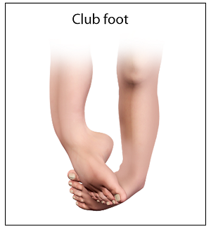 Congenital Deformity