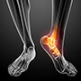 Minimally Invasive Bunion Surgery
