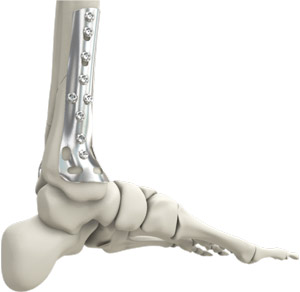 Flatfoot Reconstruction