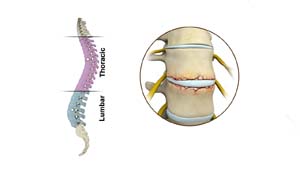 Spine Fractures