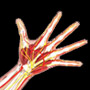 ORIF Distal Radius Fracture