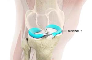 Meniscal Repair