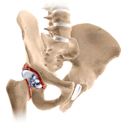 Revision Shoulder Replacement