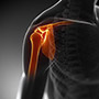 AC Joint Separation