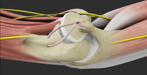 UCL Reconstruction - Tommy John Surgery